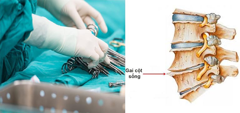 Phẫu thuật cắt bỏ gai xương cũng là một phương pháp khoa học được áp dụng