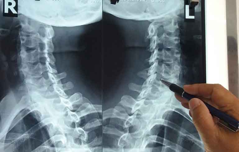 Người bệnh nên đi chụp X-quang để nhìn thấy rõ hơn hình ảnh gai xương