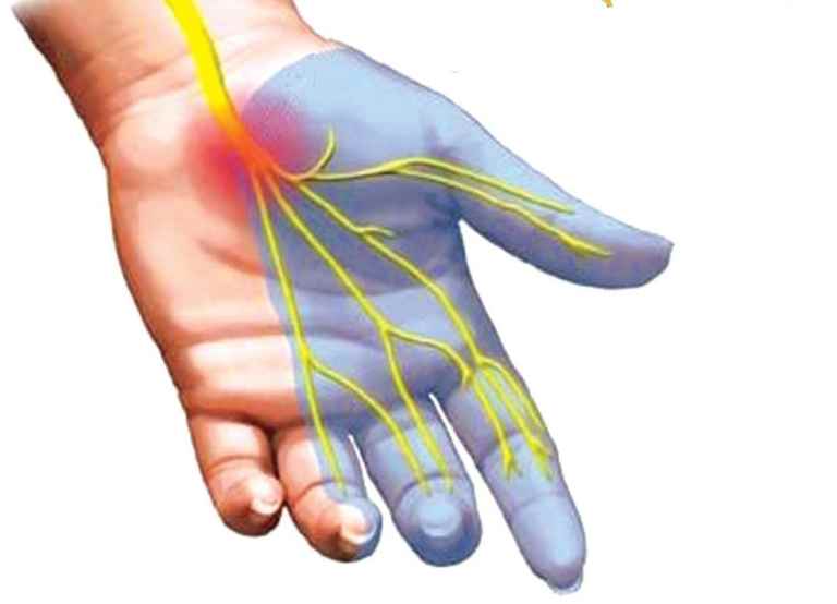 Hình minh họa hội chứng ống cổ tay 
