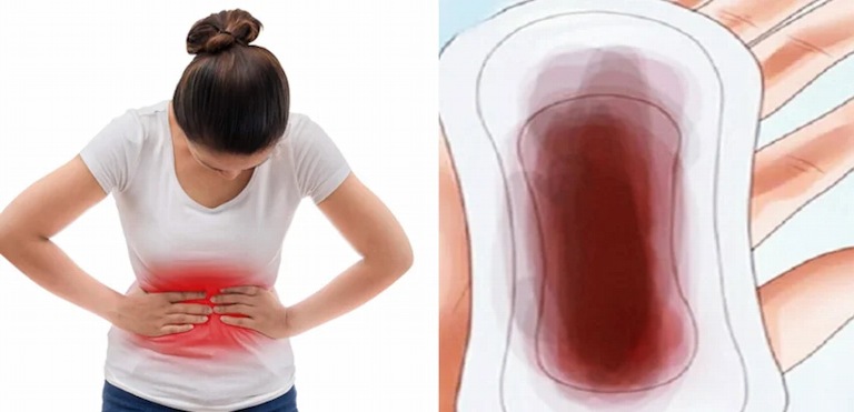 Đau lưng ra huyết nâu kèm đau bụng có thể do sinh lý hoặc bệnh lý gây nên