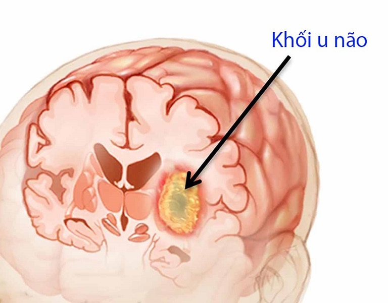 Các khối u ở não chèn ép dây thần kinh dẫn đến đau đầu
