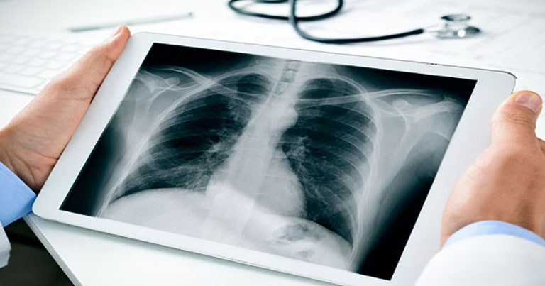 Bệnh nhân nên chụp X-quang phổi để đánh giá tổng quát
