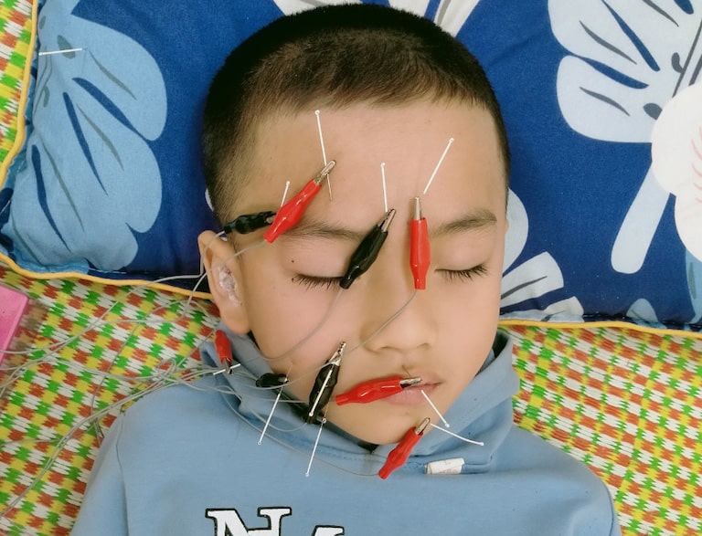 Liệt dây thần kinh số 7 có thể xảy ra ở mọi lứa tuổi, kể cả trẻ em