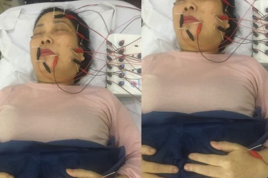 Cô Thanh được trực tiếp bác sĩ Doãn Hồng Phương thăm khám và trị liệu liêt dây thần kinh số 7