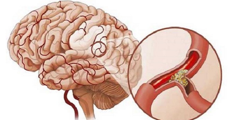 Tai biến mạch máu não thoáng qua thường xảy ra đột ngột