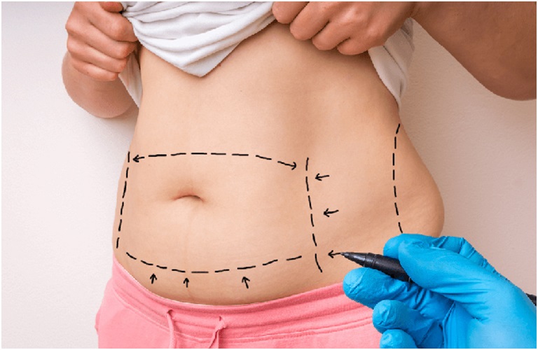 Phương pháp cắt mỡ bụng có thể cắt bỏ cả phần da thừa