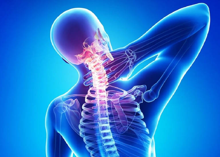 Bệnh lý về xương khớp ở cổ gây đau đầu
