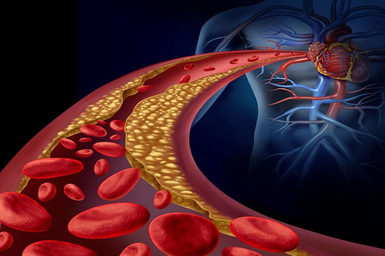 Rối loạn lipid máu gây ra nhiều hệ lụy cho sức khỏe