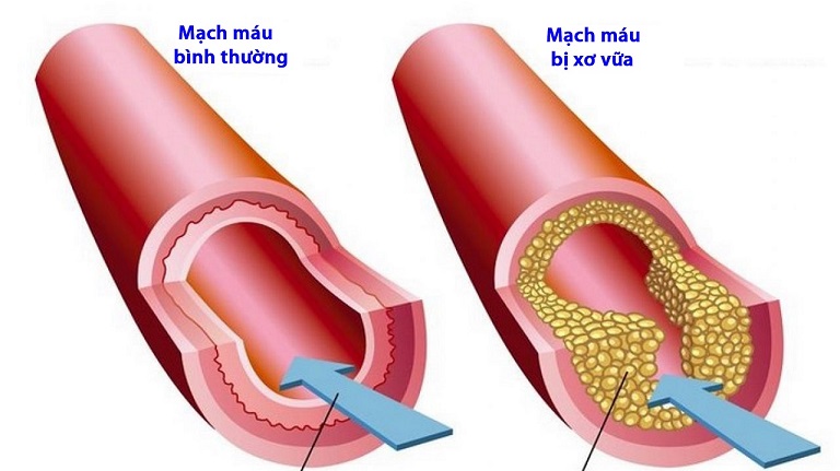 Xơ vữa động mạch là quá trình diễn ra âm thầm mỗi ngày bên trong động mạch