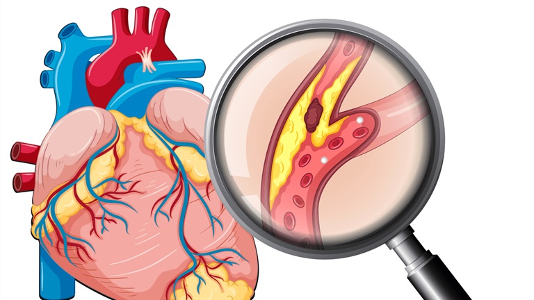 Xơ vữa động mạch vành gây ra nhiều tác động tiêu cực cho tim