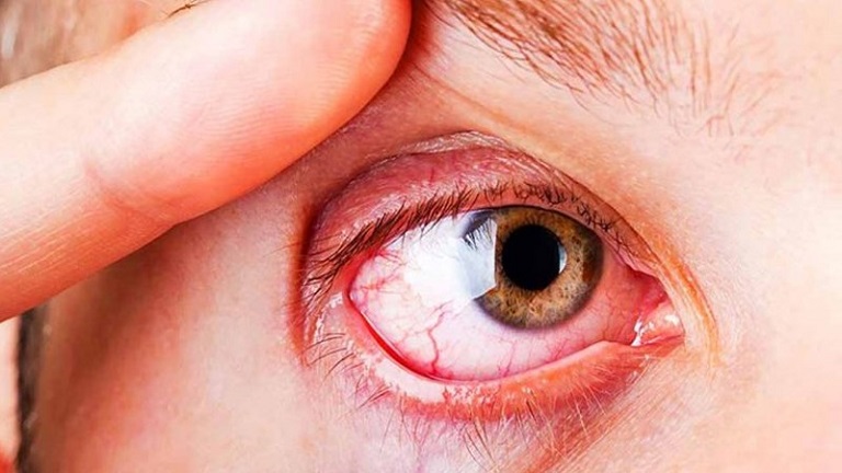 Tăng huyết áp cũng gây ảnh hưởng nghiêm trọng đến các mạch máu nhỏ bên trong mắt