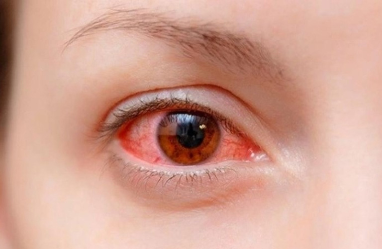 Dấu hiệu cao huyết áp ở người trẻ là xuất hiện các vệt máu trong mắt