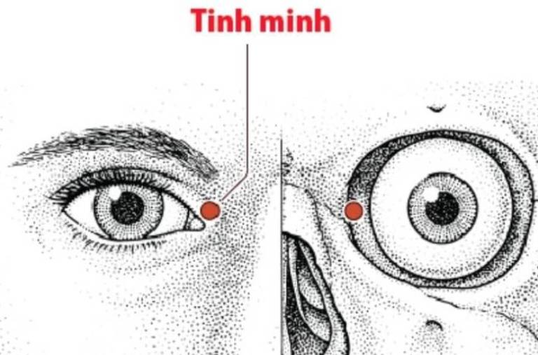 Huyệt Tinh Minh nằm gần khóe mắt, có tác dụng làm sáng mắt